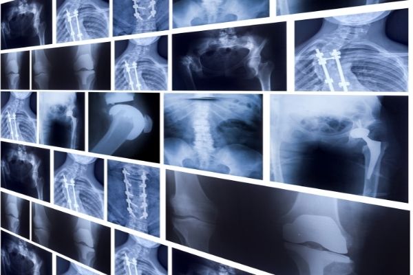 how to recycle x-rays
